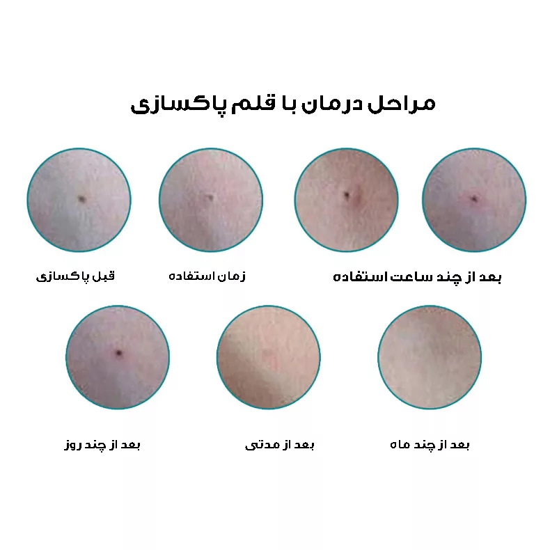 قلم پاک سازی پوست مدل دیجیتالی کد 9 سطح