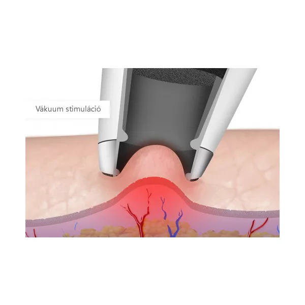 میکرودرم اسکینرا مدل IN4501