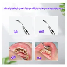 دستگاه جرمگیر دهان و دندان و مدل JYQOO2