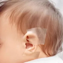 چسب اصلاح فرم گوش نوزاد کد 710