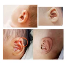 چسب اصلاح فرم گوش نوزاد کد 710